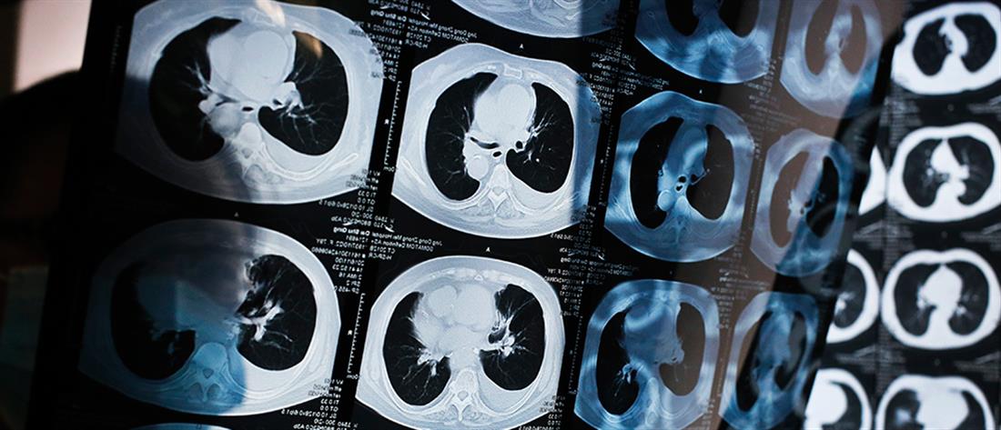 Καρκίνος πνεύμονα: Ελπίδα από χάπι που μειώνει τον κίνδυνο θανάτου